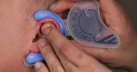 Using Ear Corrector Clips As A Natural Method